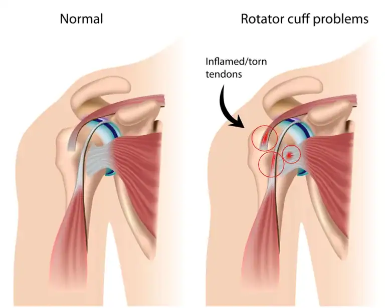 Shoulder Tendonitis Explained: Causes & Treatment